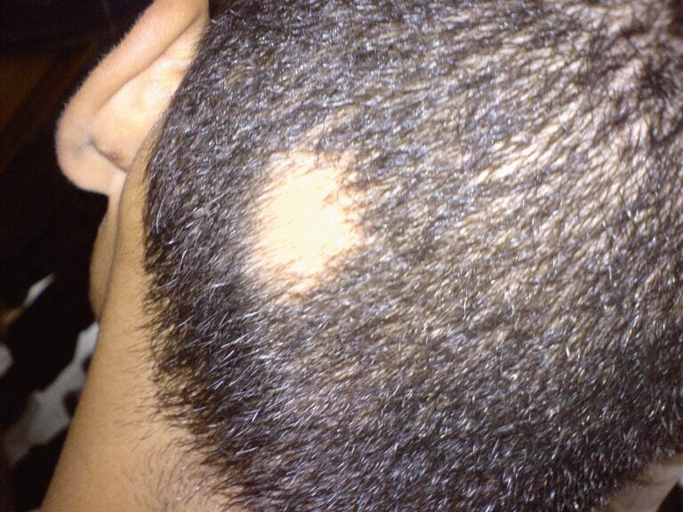 Why Do I Have a Bald Spot on the Back of My Head?