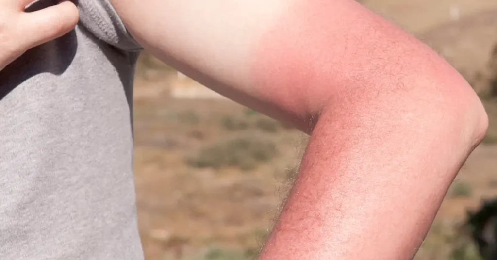 Managing Sunburn For Faster Healing