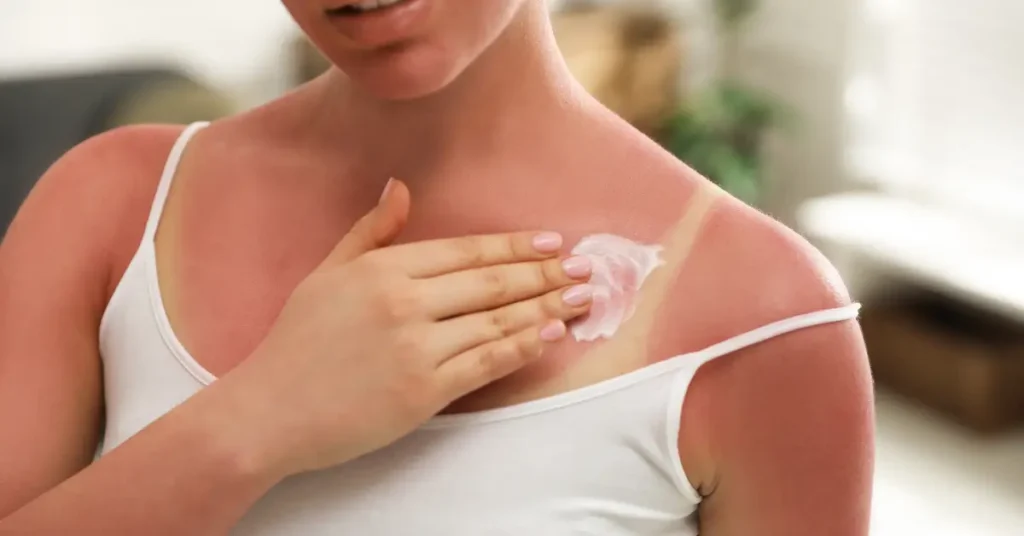 Preventing Sunburn Complications