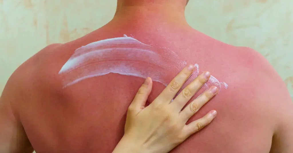 Understanding Sunburn Healing Time