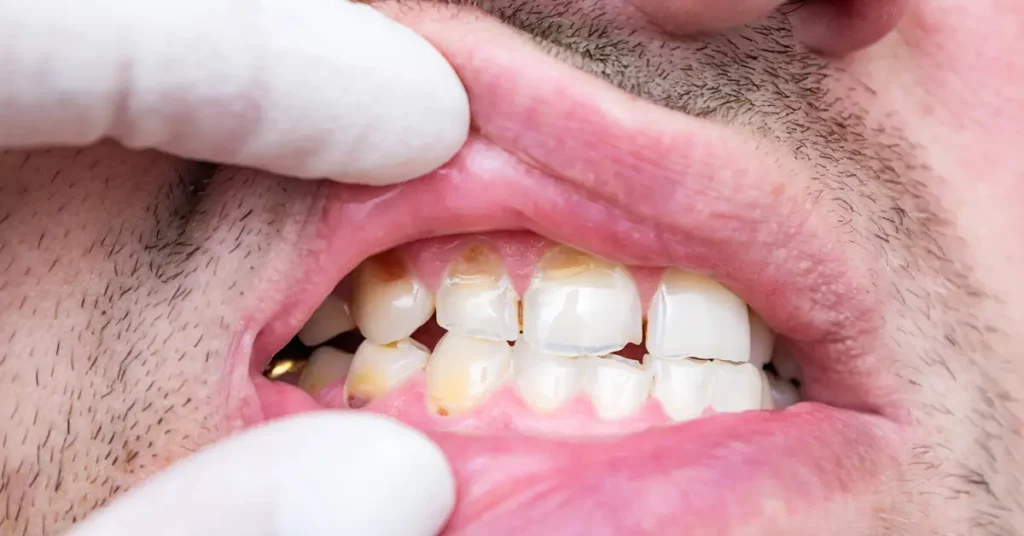 Treating Malocclusion