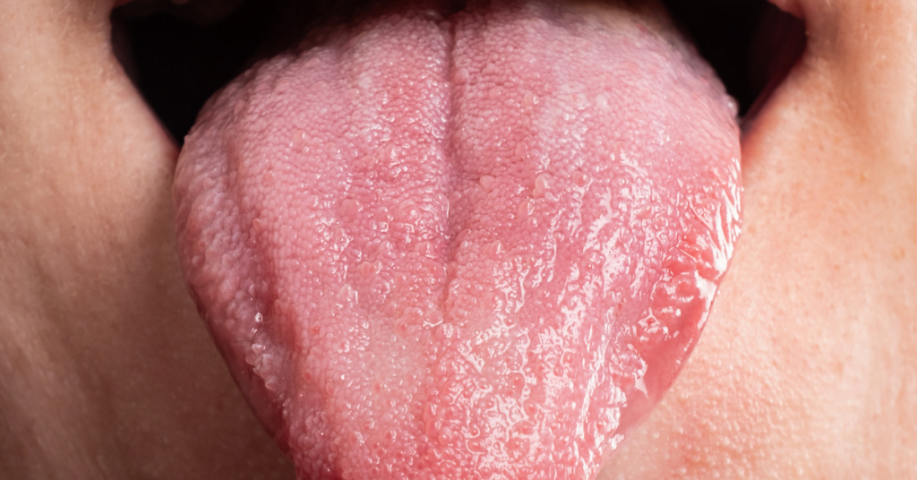 What Causes Red Dots On Tongue