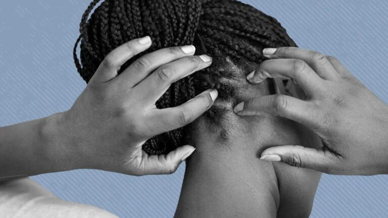 Can Scalp Acne Cause Headaches?