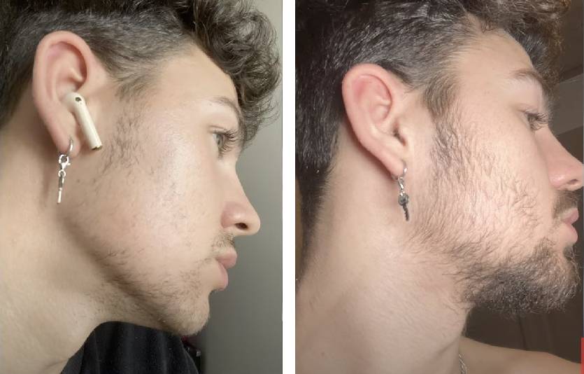 Do Derma Rollers Work For Beard Growth?