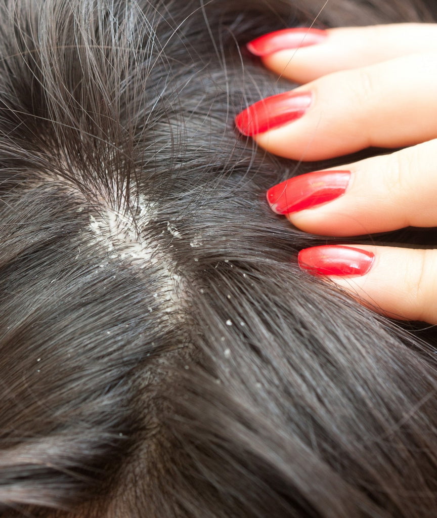 How Many Types of Dandruff And Solution- All About