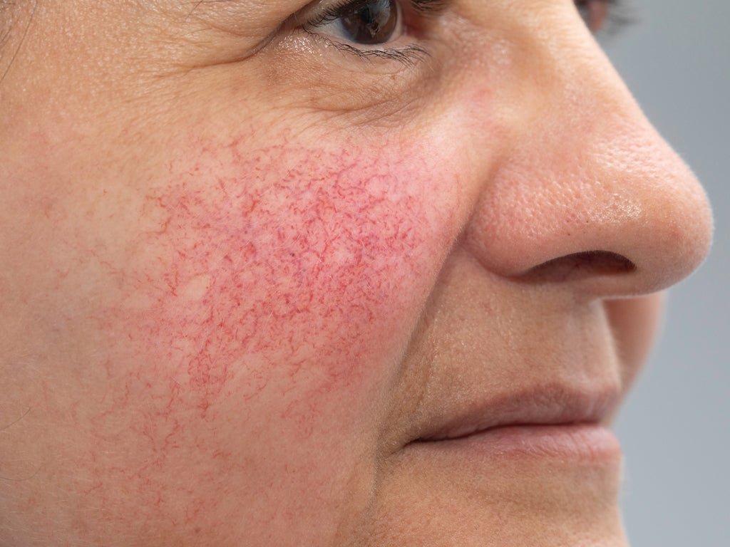 What is the main cause of rosacea? Does rosacea go away permanently?