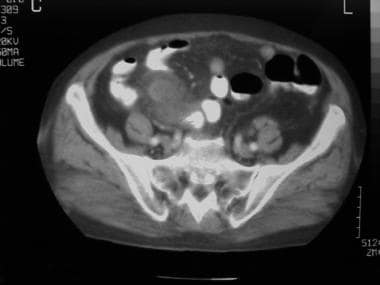 What Causes Lower Abdominal Pain in Elderly Females