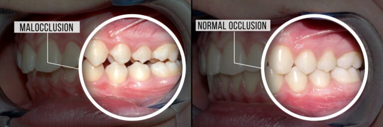 What is Malocclusion of the Teeth and How Can it be Treated?