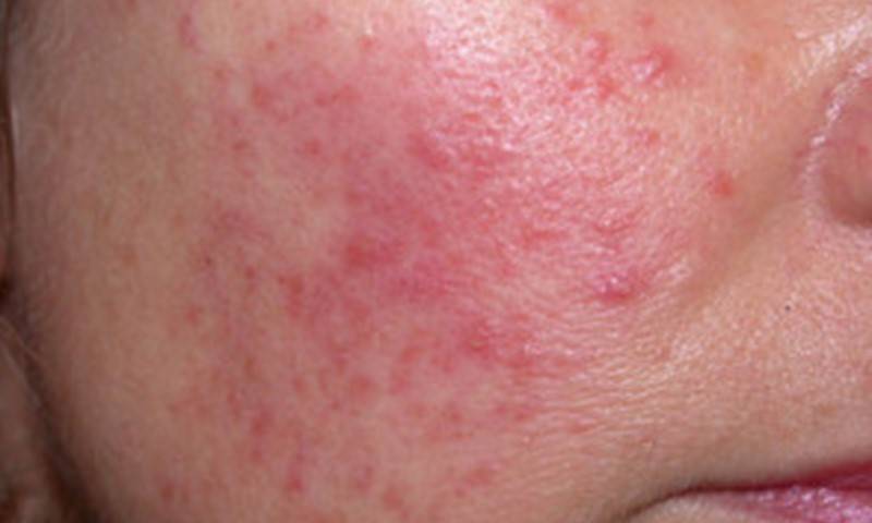 What is the main cause of rosacea? Does rosacea go away permanently?