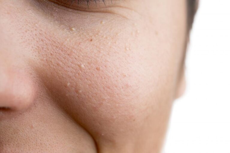 How Do You Get Rid of Little Bumps on Your Face Overnight?