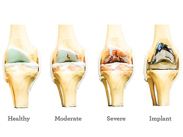 How Long Does Tourniquet Pain Last After Knee Replacement