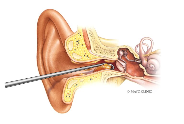 How to Clear Ear Wax Blockage