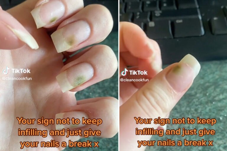 How to Get Rid of Green Nail Fungus