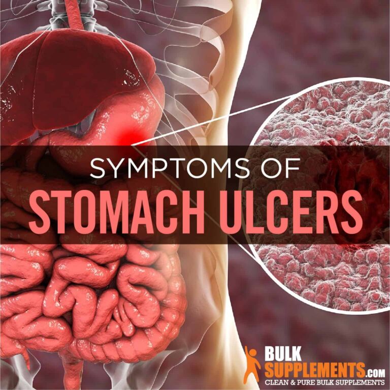 How to Know If You Have a Stomach Ulcer