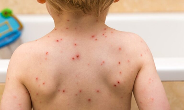 Symptoms of Chickenpox in Adults, How is Chickenpox Transmitted