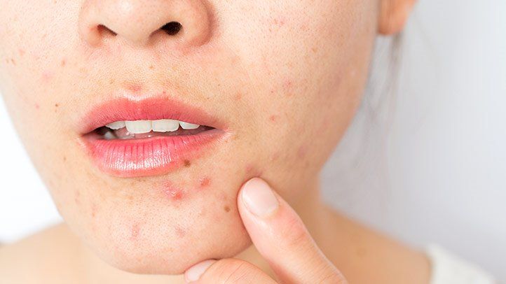 What Causes Pimple on the Face