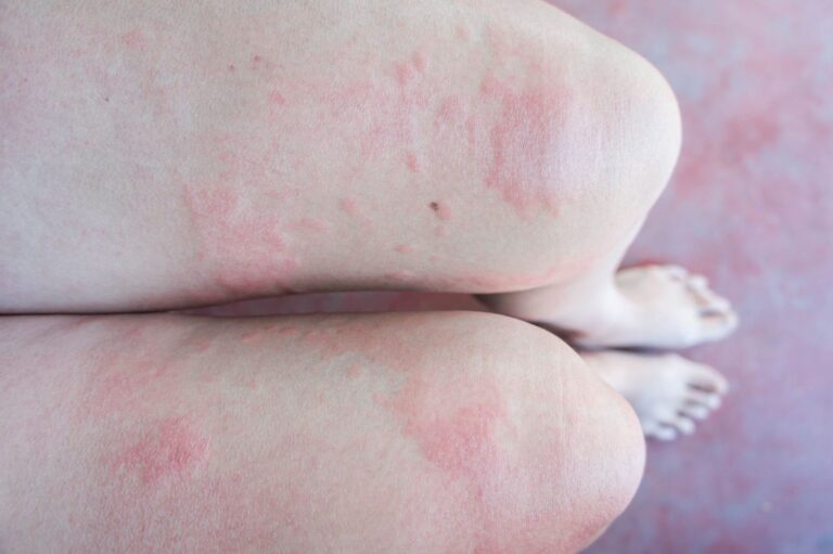 What Is A Stress Hormone & What Does A Stress Rash Look Like?