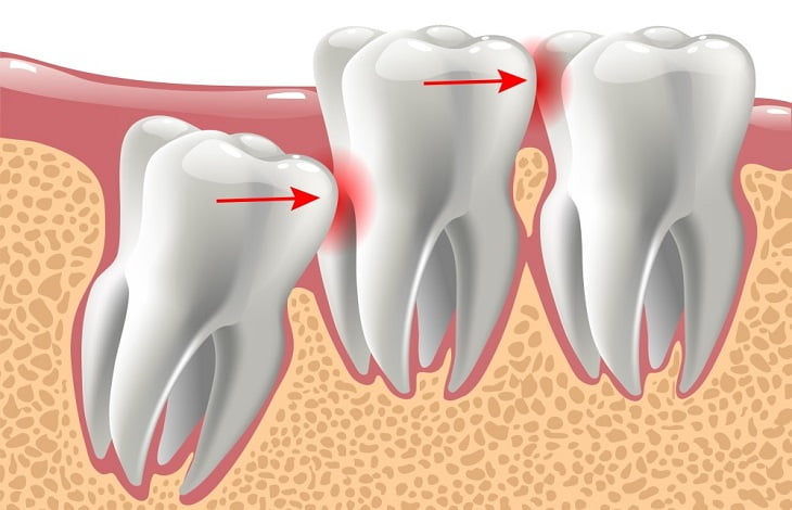 How Long Does It Take a Wisdom Tooth to Come in Once It Starts