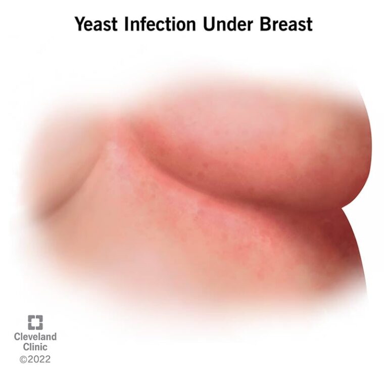 What Causes Infection under the Breast