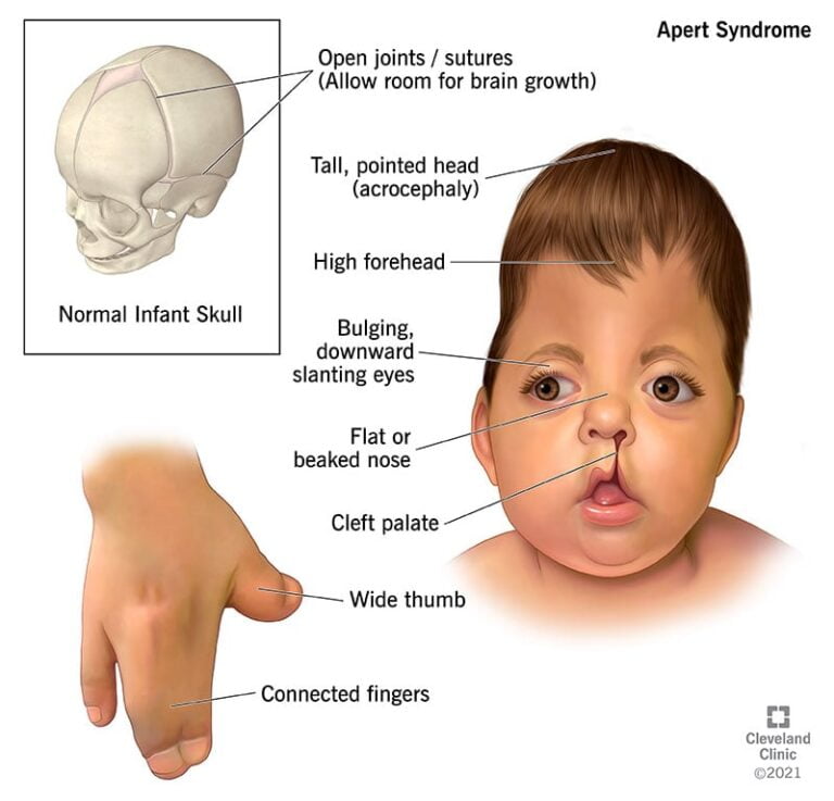 What is the Life Expectancy of Someone With Apert Syndrome