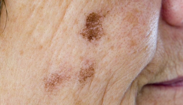 What is the Most Common Skin Problem in the Elderly?