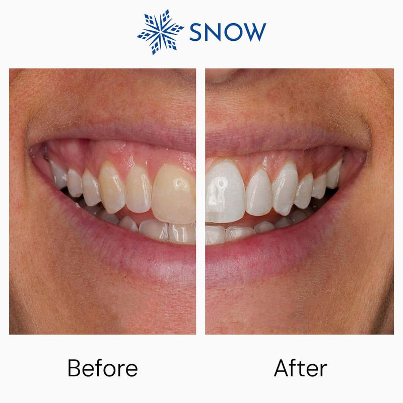 Snow At-Home Teeth Whitening Kit